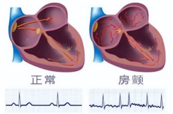 房颤的症状,揭秘心房颤动的不规则跳动与常见不适”